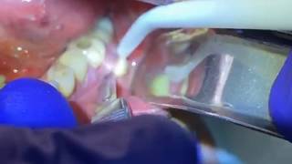 Draining a Dental Abscess  Advanced Dental Care [upl. by Ehrsam]