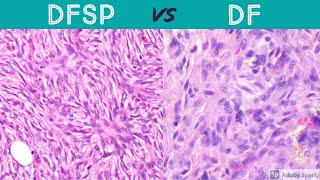 DFSP vs DF dermatofibrosarcoma protuberans vs dermatofibroma pathology dermatology dermpath [upl. by Jeannette771]