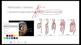 Neonatal GI serial lectures Malrotation amp Volvulus  Meconium ileus short left colon syndrome [upl. by Sedda]