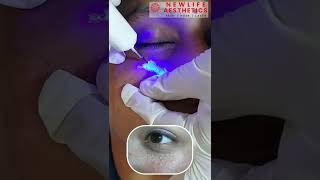 Sebaceous Hyperplasia Treatment skincare Lasersmooth padmajacosmetices shorts hyderabad [upl. by Arlee690]