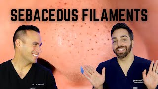 Black Dots on the Nose Heres How To Treat Sebaceous Filaments [upl. by Elsworth]