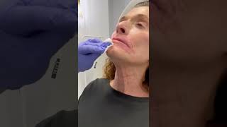 Botox for platysmal bands in the neck [upl. by Sekyere]