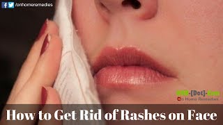 How to Get Rid of Rashes Fast  Home Remedies for Rashes on Face [upl. by Malinde896]