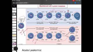 Pathology Acute Leukemia [upl. by Ehav]