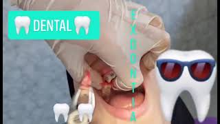 Extraction Lower Premolar Step by Step [upl. by Noneek]