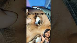 Wilson Disease  Kayser Fleischer Ring Pediatrics clincal case series [upl. by Darcie250]