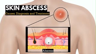 Skin Abscess Causes Signs and Symptoms Diagnosis and Treatment [upl. by Cheston765]