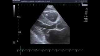 Mitral Valve Prolapse Barlow disease [upl. by Idnis]