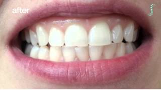 How to use Lumist Teeth Whitening Strips [upl. by Kong147]