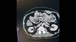 Ileocolic intussusception with lipoma as a lead point [upl. by Yenruoj]