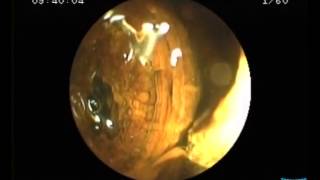 Direct Cholangioscopy with Standard Ultraslim Endoscopes [upl. by Danni]