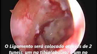 Cirurgia de Ligamento cruzado Anterior no Joelho [upl. by Schick]