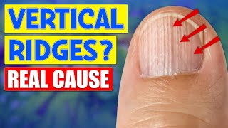 The Real Causes Behind Vertical Ridges On Nails Unveiled [upl. by Nattirb]