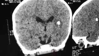 Neurocysticercosis Brain CT calcified with cerebral edema [upl. by Cumine368]