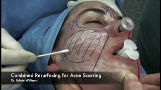 Laser amp Dermabrasion Treatment for Acne Scarring by Dr Edwin Williams [upl. by Eillah668]