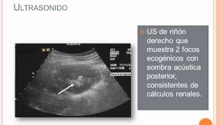 Litiasis Renal  Parte 3 [upl. by Baler]