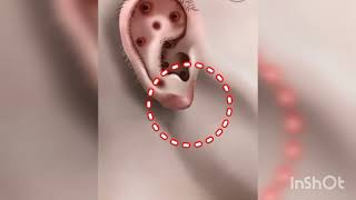 ASMR Treatment and remove for Piercingfor swollen girls ear ear piercing  ASMR video [upl. by Otrevire]