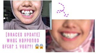 BRACES  3 month update  dental routine [upl. by Shimberg869]