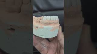 dental ceramic art emax veneers [upl. by Bundy]