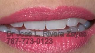 Estetica DentalProstodoncistaImplantes Dentales en Puerto Rico7877730123 [upl. by Nitsirc]