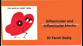 wpw syndrome and bi and trifascicular block [upl. by Poppas]