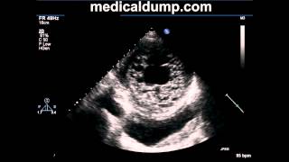 Noncompaction Of Left Ventricle  Transthoracic Echocardiogram TTE [upl. by Nord888]