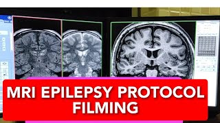 Brain Epilepsy TLE Protocol Filming [upl. by Ettecul]