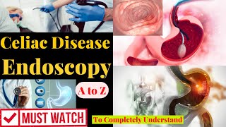 Celiac Disease Endoscopy  Endoscopy of Celiac Disease  Preparation  Celiac Disease  FBH [upl. by Keven990]