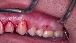 Gummy Smile Correction Surgery Dr Elie Maalouf [upl. by Giffy120]