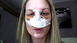 Septoplasty Recovery  Day 4 revision [upl. by Ronnholm]