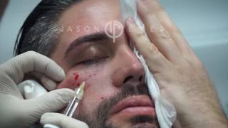 Belotero Fillers For Under Eye Hollows Dark Circles And Eye Bags  Dark Circle Treatment Live [upl. by Snahc387]