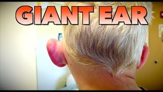 GIANT EAR Allergic Reaction or Infection  Dr Paul [upl. by Adyan]