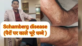 SCHAMBERG DISEASE टांगों में होने वाले धब्बे और निशान skindiseases pigmentation spots disease [upl. by Swope]