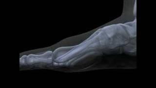 Hallux Limitus  Rigidus Surgery Functional Hallux Limitus Arthritis [upl. by Assira948]