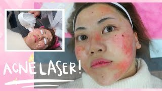 Painful ACNE LASER Experience in Korea [upl. by Rafiq40]