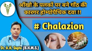 CHALAZION  पलकों का गांठ 👁️ drakguptamrj chalazion eyecare healthtips homoeopathy [upl. by Ingelbert]