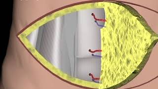 Breast Reconstruction  DIEP procedure Narration and Animation by Cal Shipley MD [upl. by Nojid]