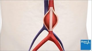 How keyhole abdominal aortic aneurysm surgery is carried out  Bupa Health [upl. by Rizzi]