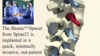 New treatment of Lumbar Spinal Stenosis [upl. by Lars]