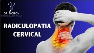 RADICULOPATIA CERVICAL [upl. by Ulysses]