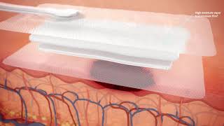 How PICO sNPWT works on open wounds [upl. by Anaert]