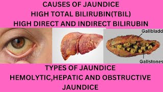 CAUSES OF JAUNDICECAUSES OF HIGH TOTAL BILIRUBINWHY IS MY DIRECT AND INDIRECT BILIRUBIN HIGH [upl. by Richard459]