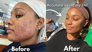 MY 6 MONTH ACCUTANE JOURNEY  side effects purging amp skin care routine  Ice Diallo [upl. by Notrub]