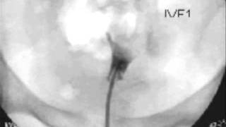 Hysterosalpingogram  HSG [upl. by Aneehsyt]