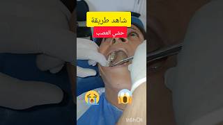 علاج جذور الاسنان حشي عصب الضرس بعد سحب العصب dentist stitch اكسبلور stitchfan ترند [upl. by Tait]