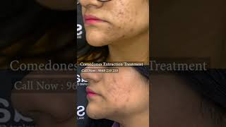 Best Comedones Extraction Treatment  Viral shorts [upl. by Suiratnod324]