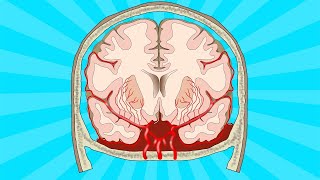 Stroke subarachnoid haemorrhage [upl. by Eitsrik]