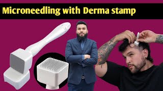 microneedling derma stamp derma roller hair regrowth  hair loss treatment  how to use derma Roler [upl. by Dnomasor]