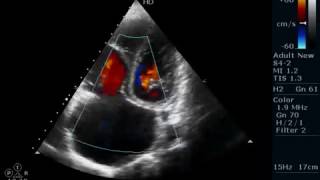 DYSPLASTIC PULMONARY VALVES ECHOCARDIOGRAPHY SERIES BY DR ANKUR K CHAUDHARI [upl. by Tutto903]