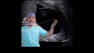 Monochorionic Diamnionic Ultrasound [upl. by Ydnas]